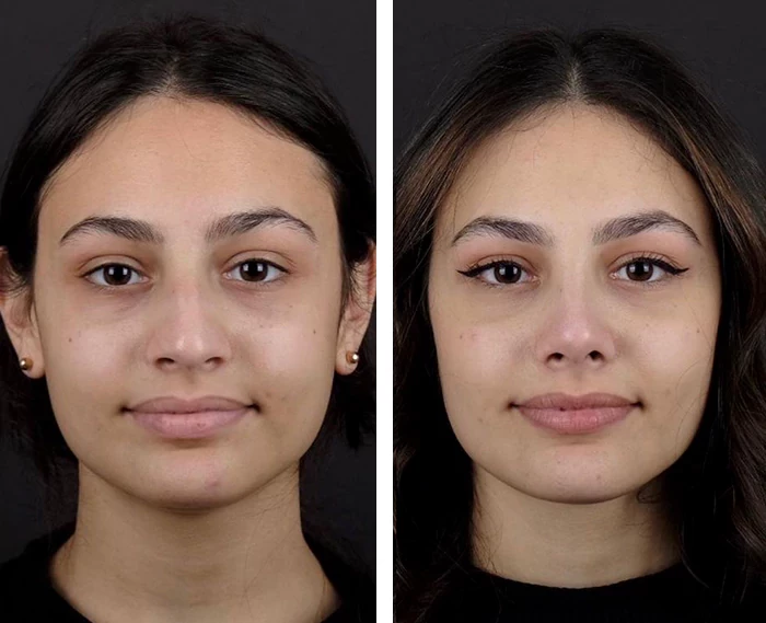 before & after photo of عملية تجميل الأنف