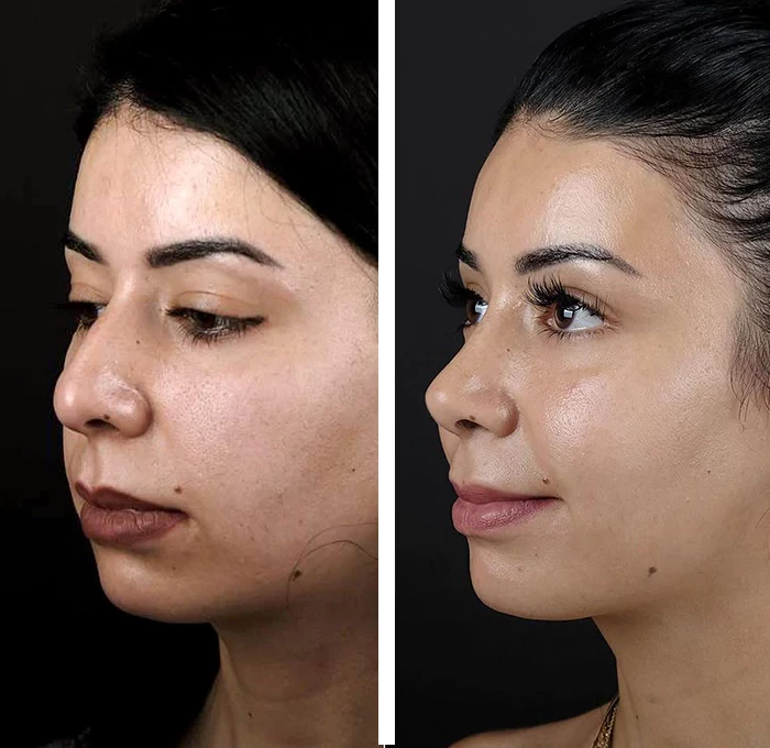 before & after photo of عملية تجميل الأنف