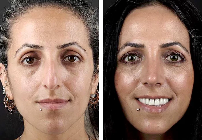 before & after photo of عملية تجميل الأنف