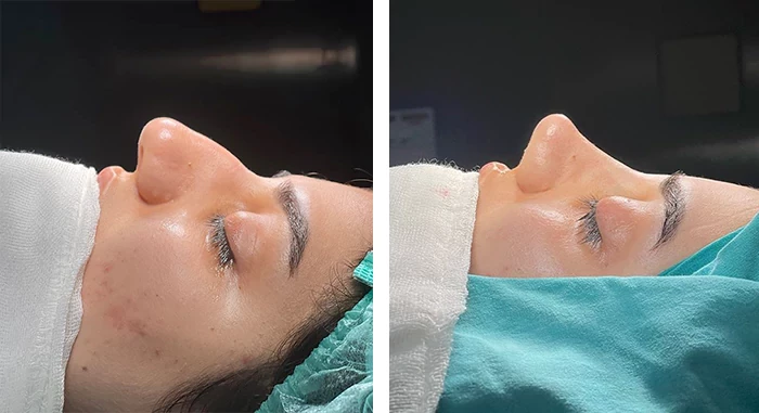 before & after photo of عملية تجميل الأنف