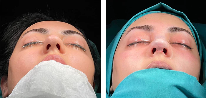 before & after photo of عملية تجميل الأنف