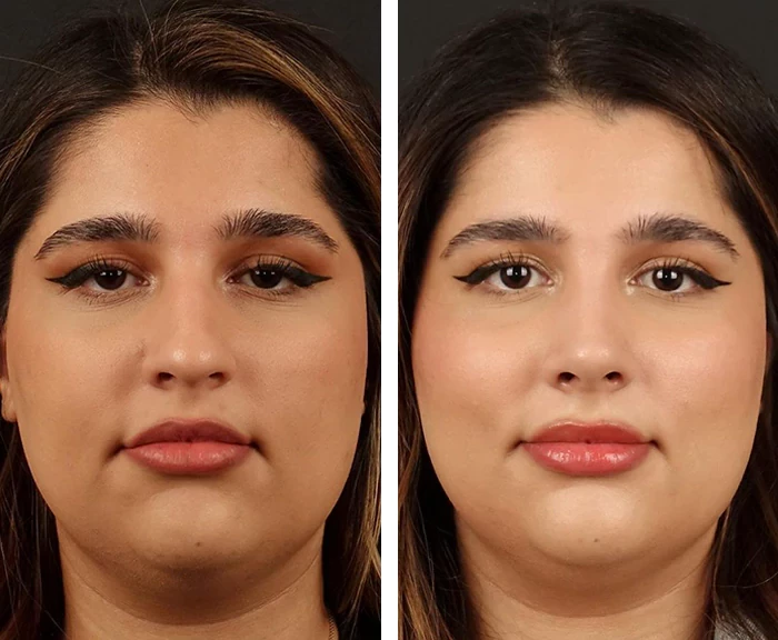 before & after photo of عملية تجميل الأنف