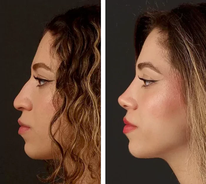 before & after photo of عملية تجميل الأنف