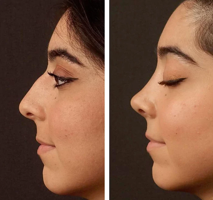 before & after photo of عملية تجميل الأنف