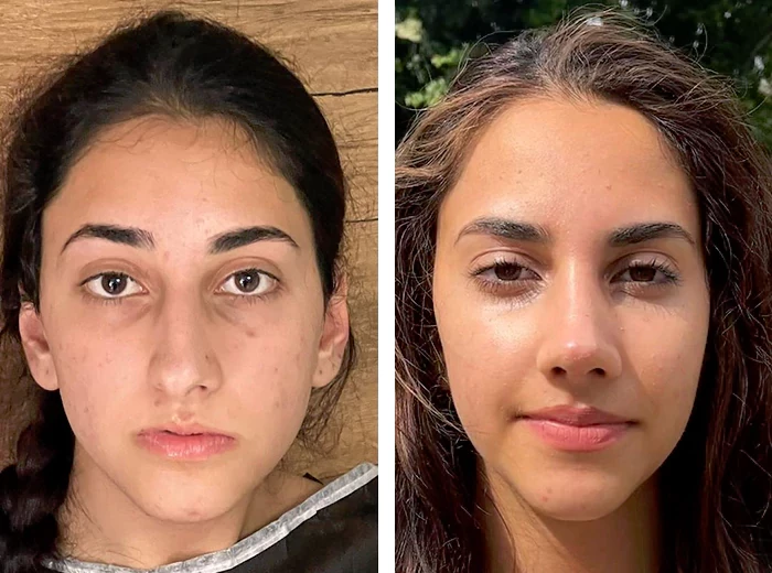 before & after photo of عملية تجميل الأنف