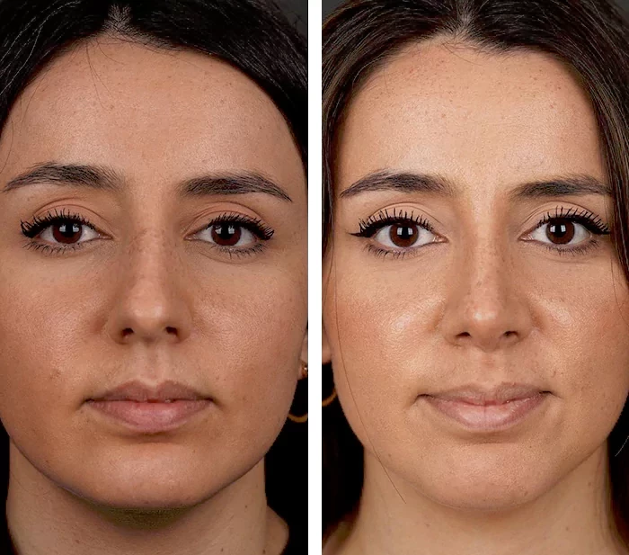 before & after photo of عملية الأنف الترميمية