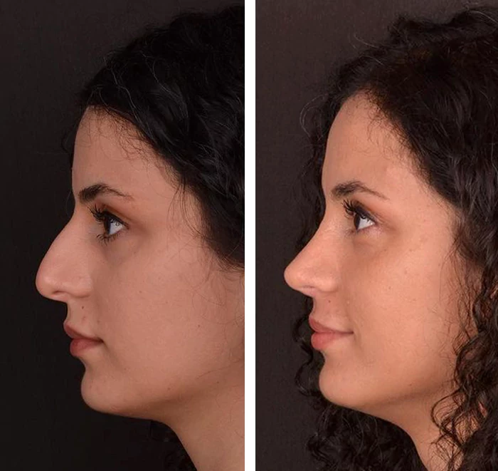 before & after photo of عملية تجميل الأنف