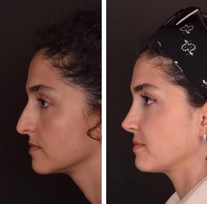 before & after photo of عملية تجميل الأنف