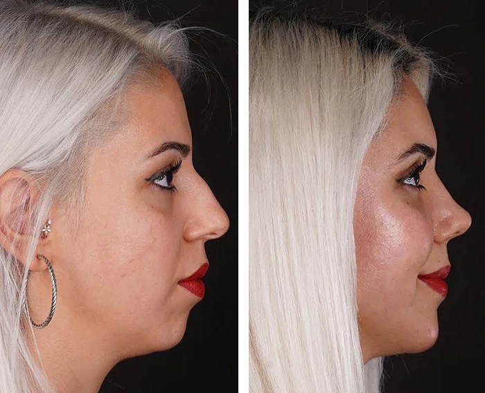 before & after photo of Rhinoplasty