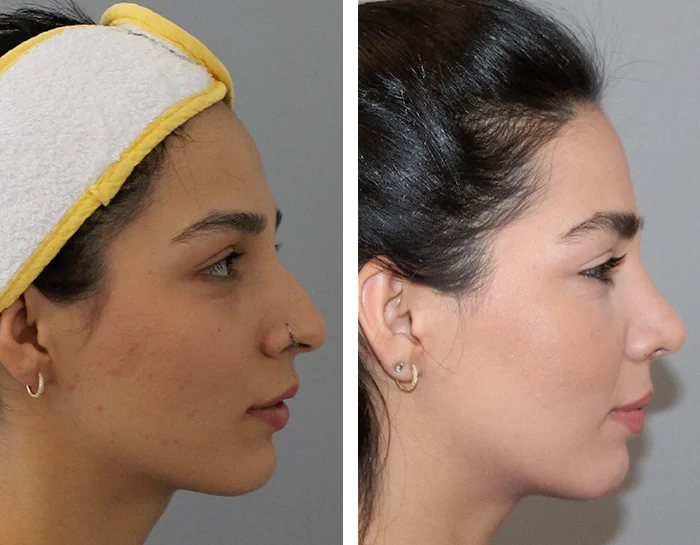 before & after photo of Rhinoplasty