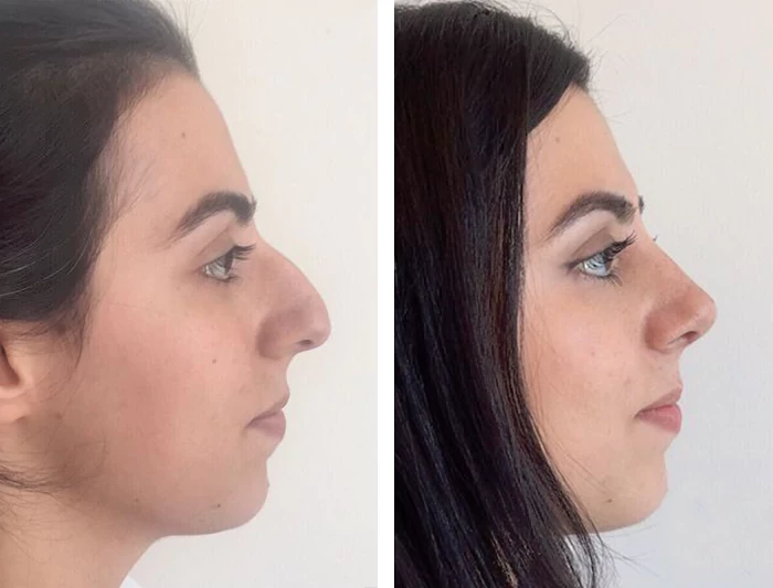 before & after photo of عملية تجميل الأنف