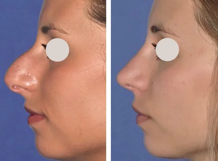 before & after photo of Rhinoplasty