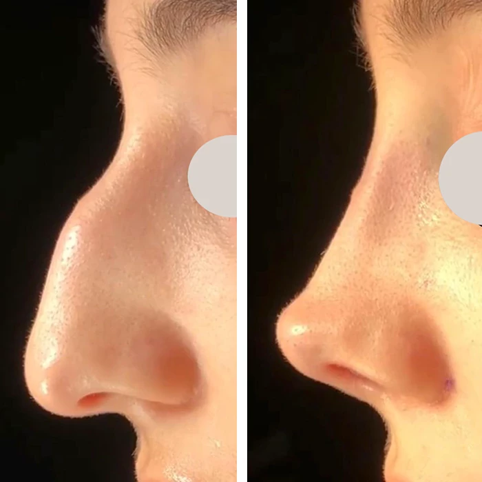 before & after photo of Rhinoplasty