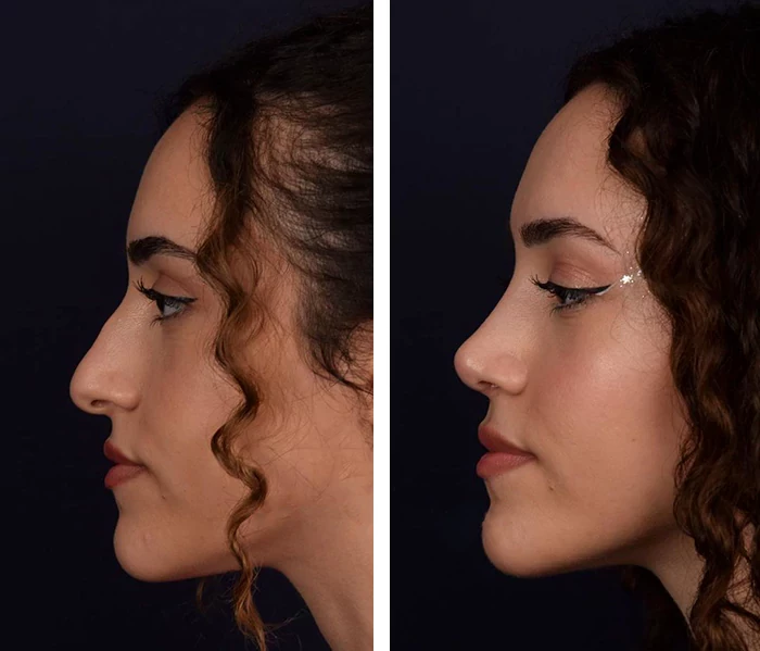 before & after photo of Rhinoplasty