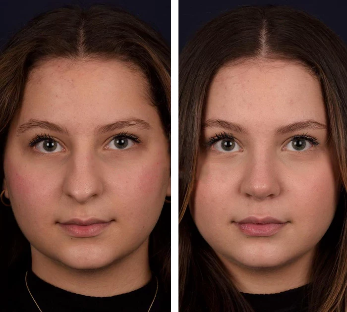 before & after photo of Rhinoplasty