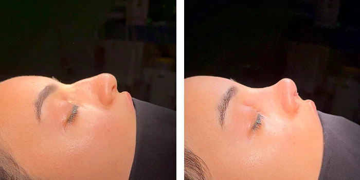 before & after photo of Rhinoplasty