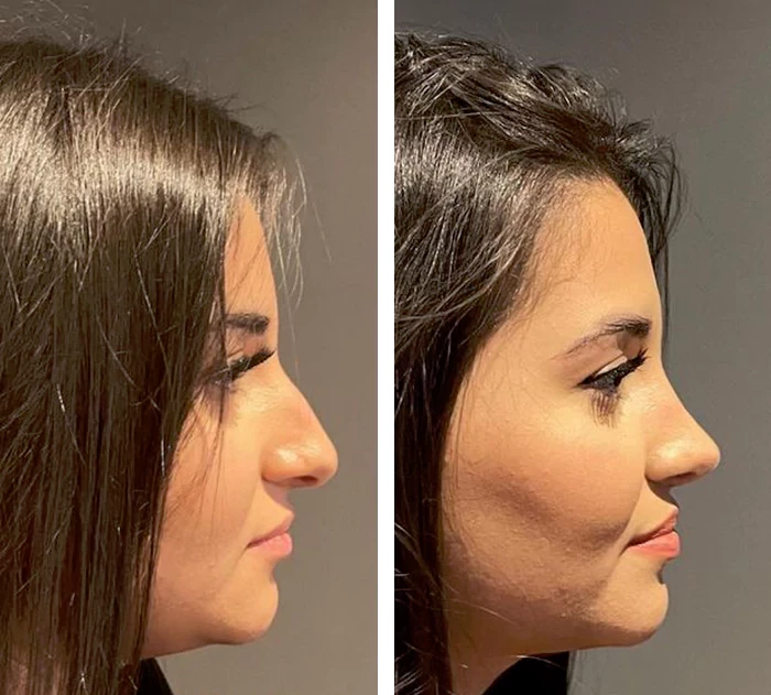 before & after photo of عملية تجميل الأنف