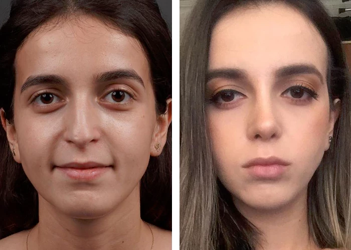 before & after photo of عملية تجميل الأنف