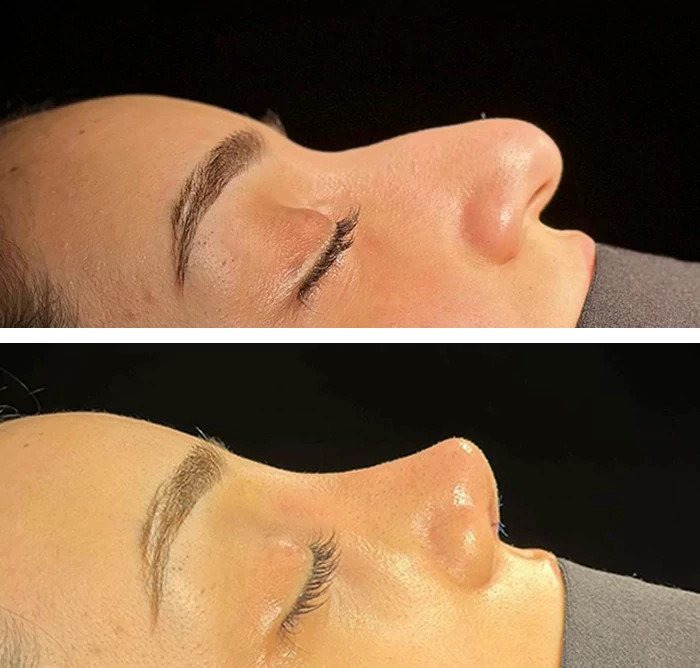 before & after photo of Rhinoplasty