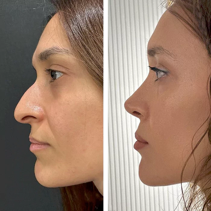 before & after photo of Rhinoplasty