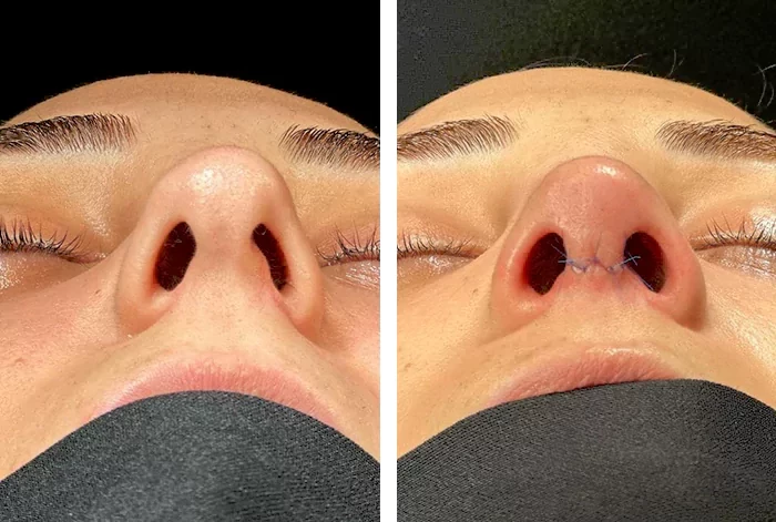 before & after photo of Rhinoplasty