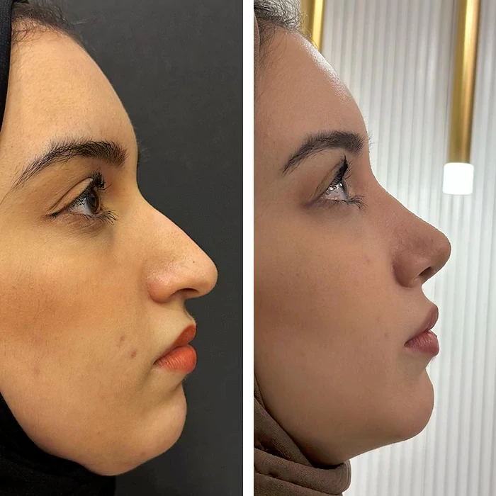 before & after photo of عملية تجميل الأنف