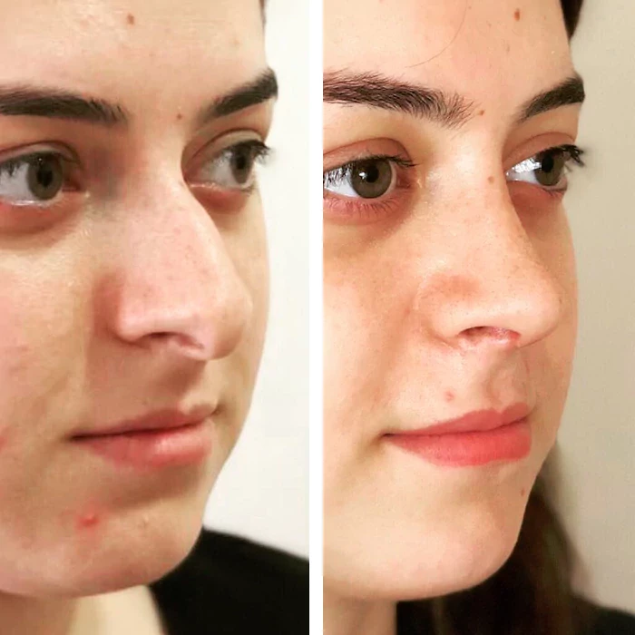 before & after photo of Rhinoplasty