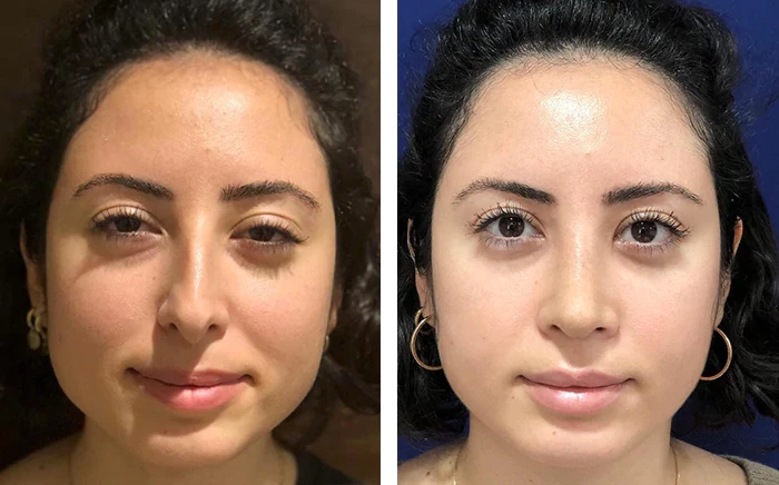 before & after photo of عملية تجميل الأنف