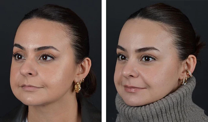 before & after photo of عملية تجميل الأنف