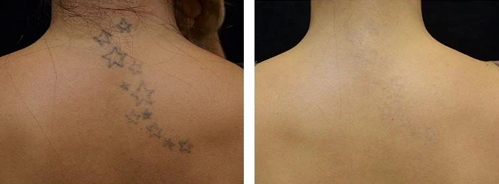 before & after photo of Tattoo Removal Surgery