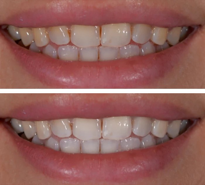 before & after photo of Teeth Whitening