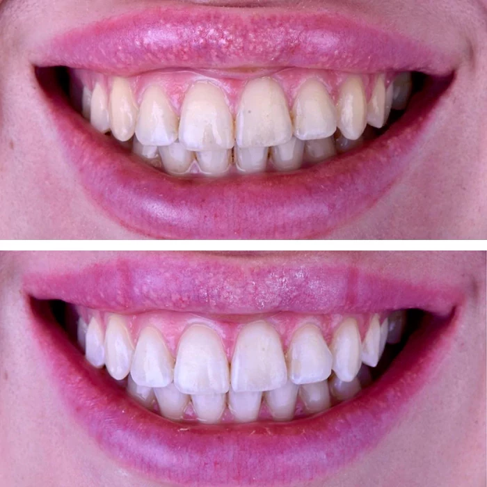 before & after photo of Teeth Whitening