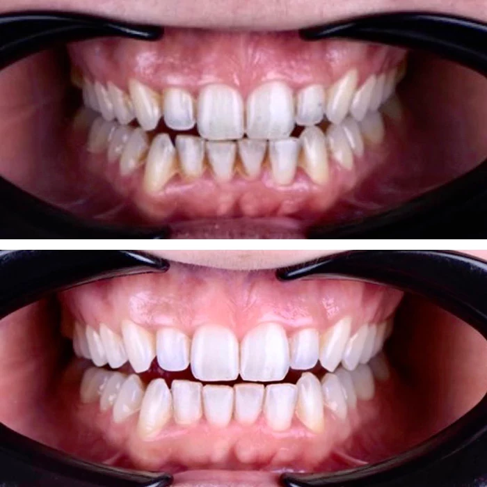 before & after photo of Teeth Whitening