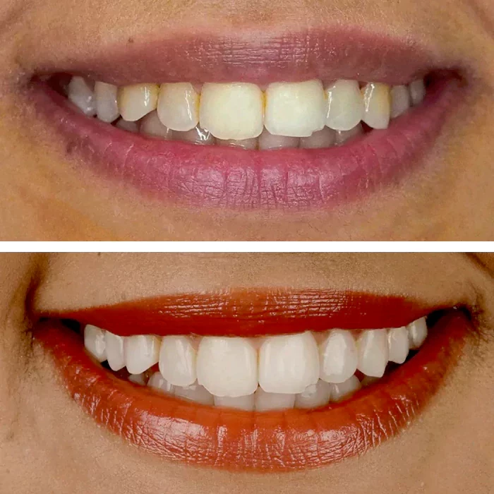 before & after photo of Teeth Whitening