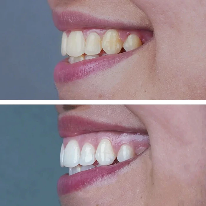 before & after photo of Teeth Whitening