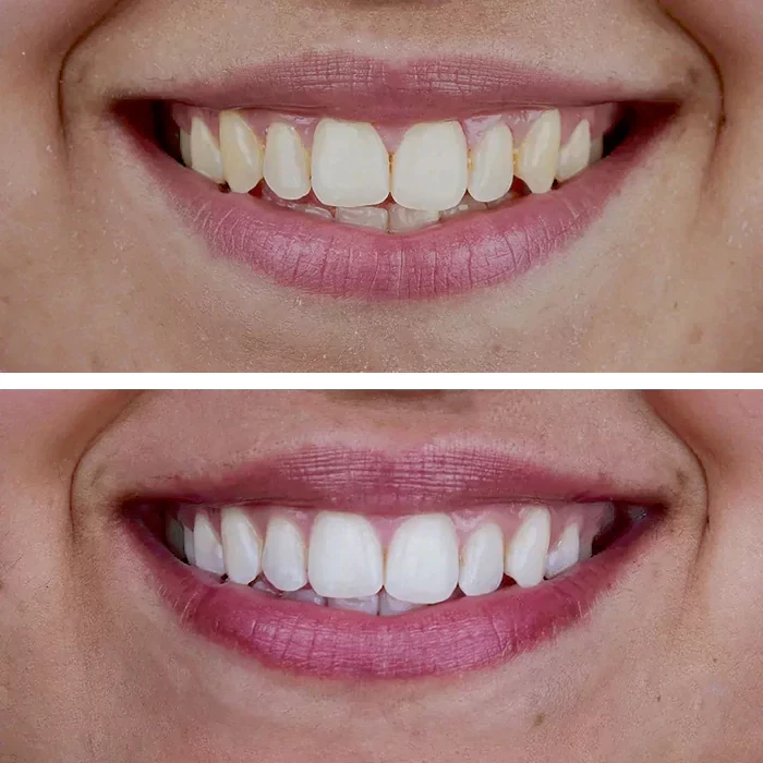 before & after photo of Teeth Whitening