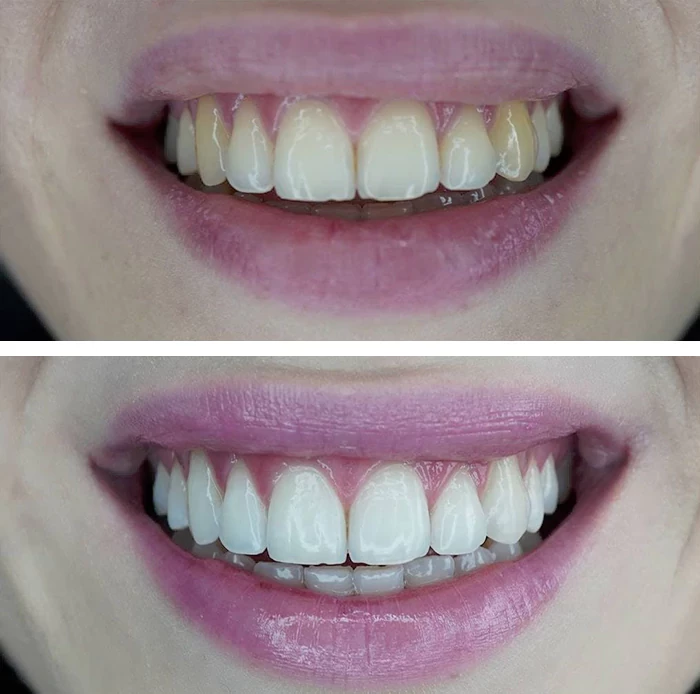 before & after photo of Teeth Whitening