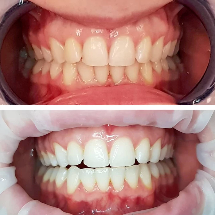 before & after photo of Teeth Whitening