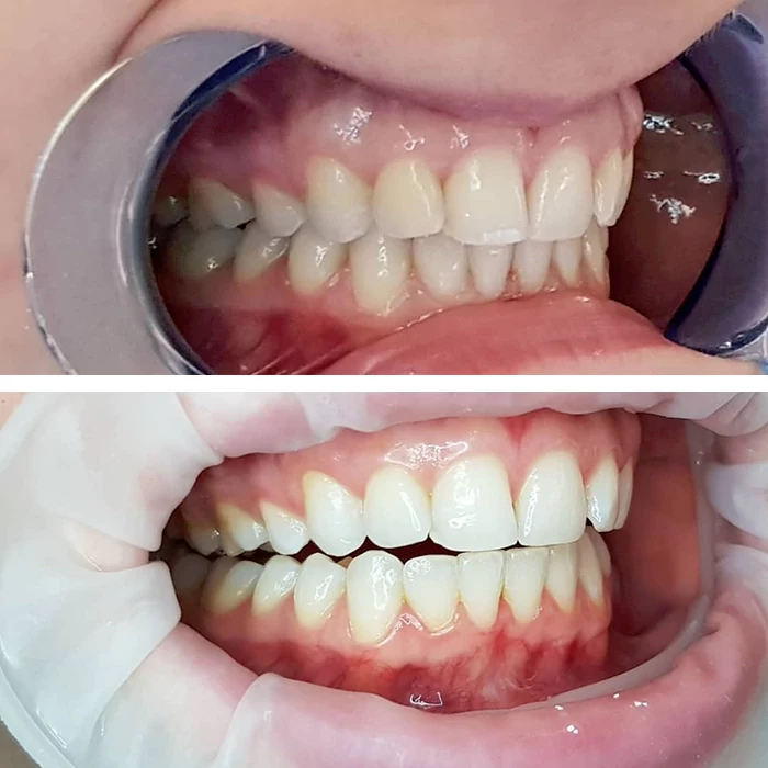 before & after photo of Teeth Whitening