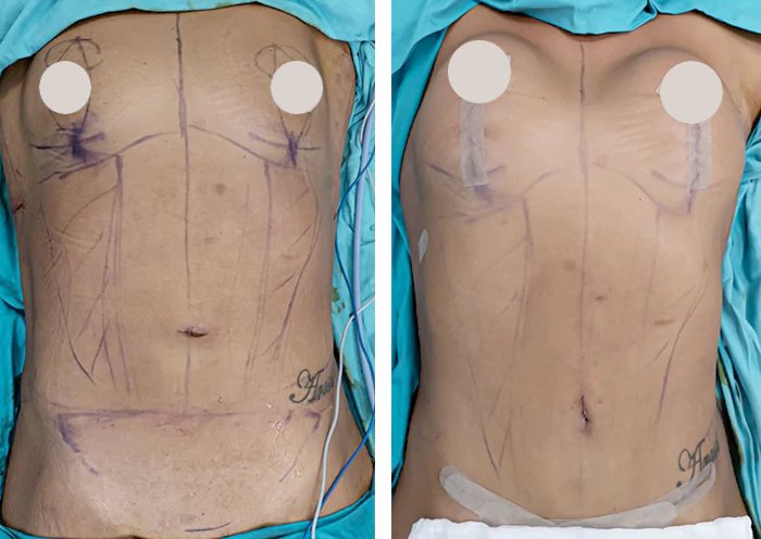 before & after photo of Tummy Tuck