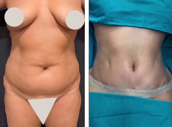 before & after photo of Brazilian Butt Lift