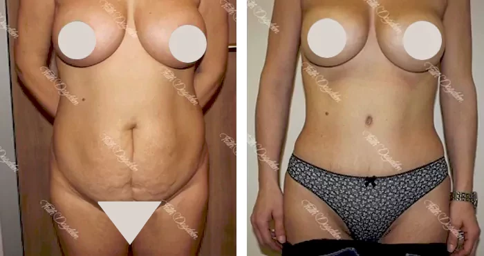 before & after photo of Tummy Tuck