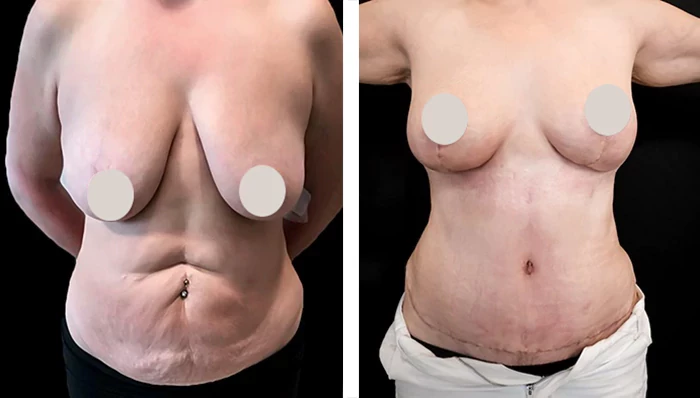 before & after photo of Tummy Tuck