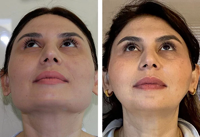 before & after photo of jaw-surgery