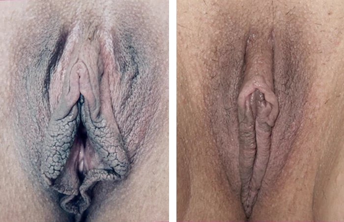 before & after photo of Vaginoplasty