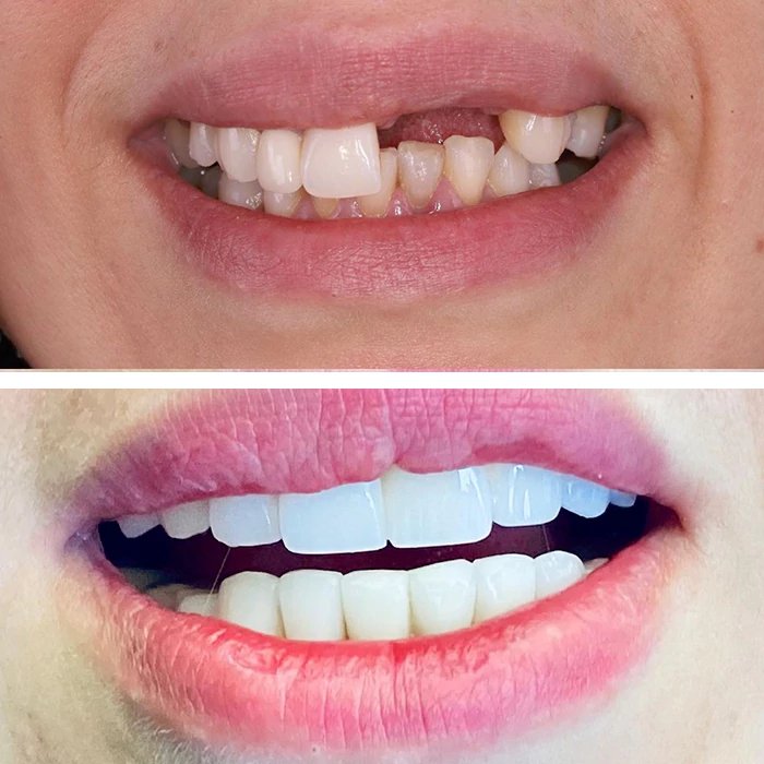 before & after photo of dental-bridge