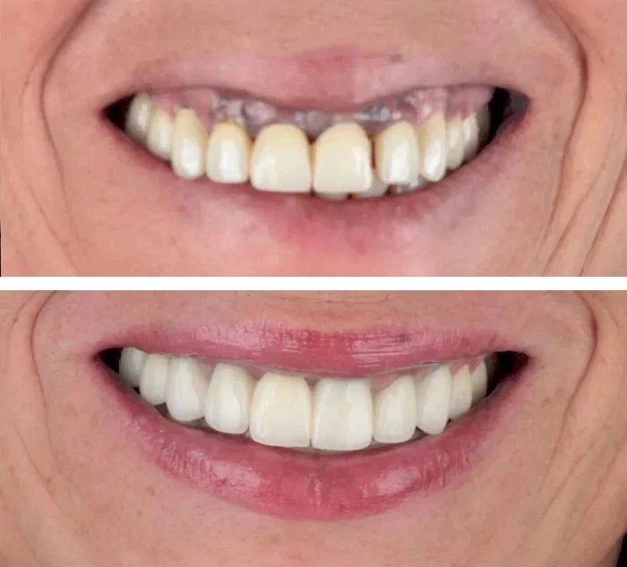 before & after photo of Dental Crown