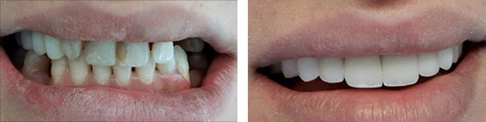 before & after photo of Dental Crown