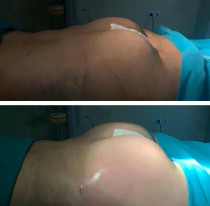 before & after photo of Brazilian Butt Lift