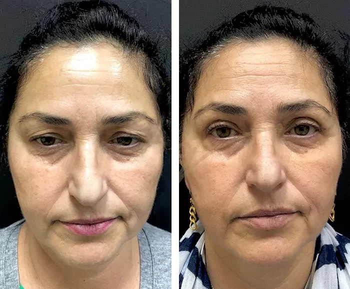 before & after photo of عملية تجميل الجفون